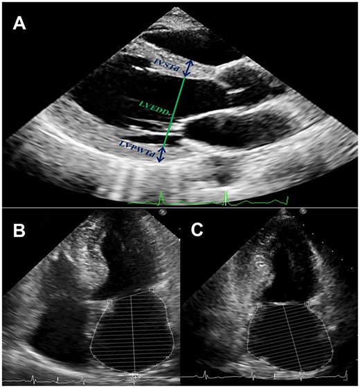 Measurement of left ventricular and left atrial echocardiographic parameters. (A) A representative parasternal long-axis view showing the method for measuring IVSTd, LVEDD, and LVPWTd at end-diastole. (B) A representative apical four-chamber view showing the method for measuring LAV at end-systole using biplane Simpson’s algorithm. (C) A representative apical two-chamber view showing the method for measuring LAV at end-systole using biplane Simpson’s algorithm. IVSTd, interventricular septum thickness at end-diastole; LAV, left atrial volume; LVEDD, left ventricular end-diastolic diameter; LVPWTd, left ventricular posterior wall thickness at end-diastole.
