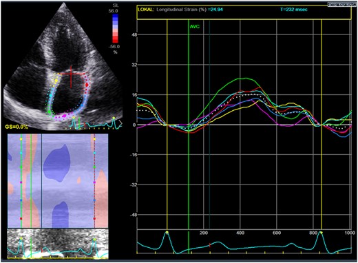 Measurement of left atrial strain by two-dimensional speckle tracking. The coloured lines denote regional strain and the white dotted line denotes the averaged value of left atrial strain.