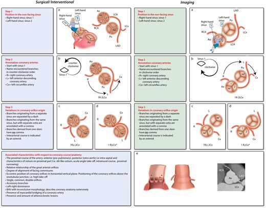 The surgical and interventional Leiden Convention (left) and the imaging Leiden Convention (right). Ao, aorta; LAD, left anterior descending artery; LCA, left coronary artery; LCx, circumflex artery; NF, non-facing sinus; Pu, pulmonary artery; RCA, right coronary artery. Figure derived and modified with permission from Gittenberger-de Groot et al.7