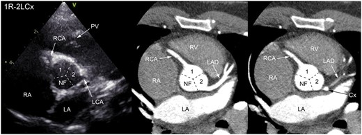 Normal coronary anatomy (1R-2LCx) on echocardiogram and computed tomography scan. The coronary anatomy is seen on two different trans-axial levels in one patient. Cx, circumflex artery; LA, left atrium; LAD, left anterior descending artery; LCA, left coronary artery; NF, non-facing sinus; PV, pulmonary valve; RA, right atrium; RCA, right coronary artery; RV, right ventricle.