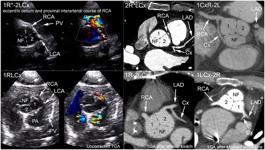 Examples of the application of the imaging Leiden Convention for anomalous coronary arteries and transposition of the great arteries on echocardiogram (with and without colour Doppler) and computed tomography scan. Cx, circumflex artery; LAD, left anterior descending artery; LCA, left coronary artery; NF, non-facing sinus; PA, pulmonary artery; PV, pulmonary valve; RCA, right coronary artery; TGA, transposition of the great arteries.