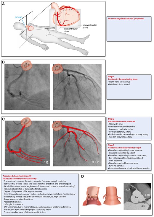The surgical Leiden Convention for coronary angiography. Ao, aorta; BAV, bicuspid aortic valve; LAD, left anterior descending artery; LCx, circumflex artery; RAO, right anterior oblique; RCA, right coronary artery; NF, non-facing sinus. The bottom panels are derived and modified with permission from Gittenberger-de Groot et al.7