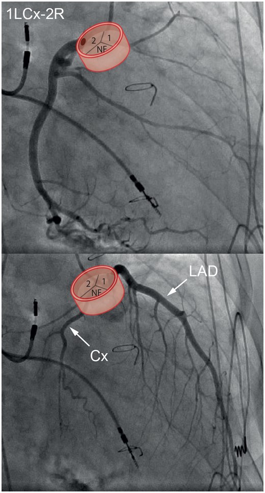 Non-angulated right anterior oblique 30° view of patient with transposition of the great arteries after Mustard procedure. Cx, circumflex artery; LAD, left anterior descending artery; NF, non-facing sinus.