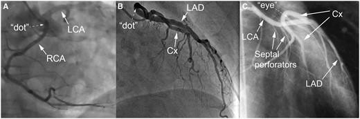 (A) RCA from sinus 2 with interarterial course. Note more intense contrast proximally, because vessel is seen on end (‘dot’). (B) LCA from sinus 1 with interarterial course (RCA not visualized). Note more intense contrast proximally, because vessel is seen on end (‘dot’). (C) LCA from sinus 1 with septal course (RCA not visualized). Cx, circumflex artery; LAD, left anterior descending artery; LCA, left coronary artery; RCA, right coronary artery. Images derived and modified with permission from Vliegen et al.18
