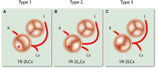 The Leiden Convention applied to bicuspid aortic valves. The star marks the non-facing sinus. Cx, circumflex artery; L, left anterior descending artery; R, right coronary artery.