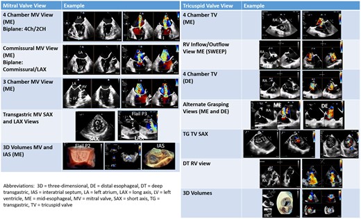 Primary imaging views for the mitral and tricuspid valve. The primary imaging views used for pre-procedural planning and intra-procedural guidance are shown in this figure.