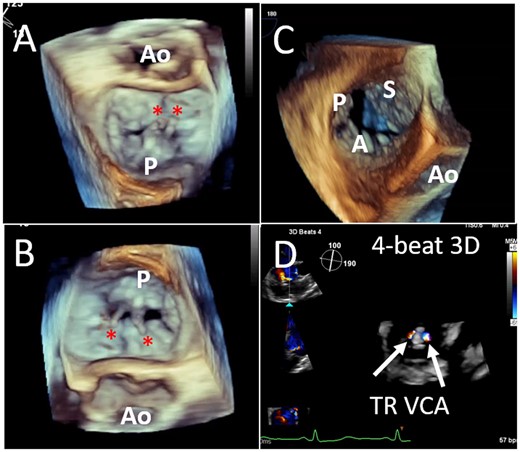 Three-dimensional imaging of the mitral and tricuspid valves. Standardized imaging display for the en face view of the MV with both lateral and Z-plane rotation (A) and without Z-plane rotation (B); ruptured P2 chordae are seen (asterisk). A real-time 3D en-face view of the TV without Z-plane rotation, results in leaflet orientation similar to the transgastric view (C). Creating multi-beat colour Doppler 3D volumes of the systolic regurgitant jet, allows planimetry of the MR VCA post-device (D). MR, mitral regurgitation; MV, mitral valve; TV, tricuspid valve; VCA, vena contracta area.