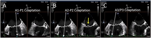 Biplane imaging from the MV commissural view. Using simultaneous biplane imaging with the mid-oesophageal MV commissural view as the primary image, a sweep of the entire commissure can be performed. (A) The position of the orthogonal image (white arrow) at the lateral commissure (A1-P1 scallops). (B) The position of the orthogonal image at the midline (A2-P2 scallops) where a small flail posterior scallop is imaged (yellow arrow). (C) The position of the orthogonal image at the medial commissure (A3-P3 scallops). MV, mitral valve.