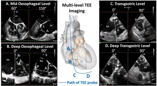 Four levels of imaging for the tricuspid valve. The path of the oesophagus allows for the generation of four imaging levels for the tricuspid valve: mid oesophageal level, deep oesophageal level , transgastric and deep transgastric. A, anterior leaflet; Ao, aorta; LA, left atrium; LV, left ventricle; P, posterior leaflet; RA, right atrium; RV, right ventricle; S, septal leaflet.