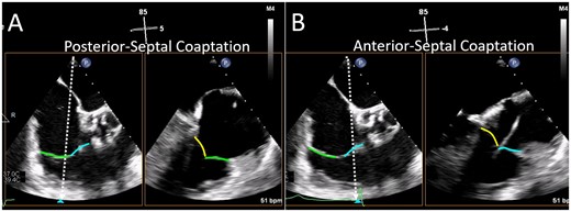 Biplane imaging from the TV commissural view. The mid-oesophageal right ventricular inflow-outflow view (at ∼50–80°) is considered the TV ‘commissural’ view with the anterior (blue line) and posterior (green line) leaflets imaged and the septal leaflet (yellow line) behind the imaging plane. Moving the orthogonal biplane cursor towards the posterior wall (A) images the posterior and septal leaflets. Moving the orthogonal biplane cursor towards the aorta (B) images the anterior leaflet near the aorta and the septal leaflet. TV, tricuspid valve.
