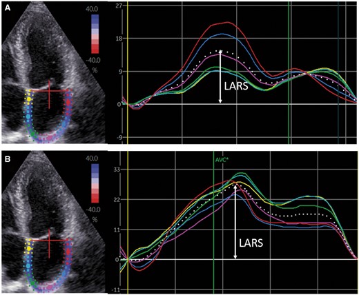 Left atrial speckle tracking strain analysis. LA speckle tracking strain analysis in CRT recipients was performed in an apical four-chamber view. Regional strain vs. time curves are represented by coloured lines, while the average LA strain vs. time curve is represented by the dotted line. LARS is indicated by the arrow. (A) Shows the LA strain before CRT implantation (LARS 15%), whereas (B) shows the LA strain after CRT implantation (LARS 27%). CRT, cardiac resynchronization therapy; LA, left atrial; LARS, left atrial reservoir strain.