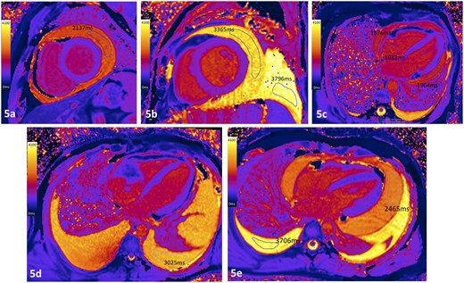 Case examples of T1 maps from patients with effusions of different etiologies. (A) Pericardial exudate in patient with active fibrinous pericarditis; (B) pericardial transudate in patient with severe LV systolic dysfunction (pleural effusion also a transudate); (C) patient with hemopericardium following complicated endomyocardial biopsy where the measured intracardiac blood and pericardial fluid T1 values were similar; (D) pleural exudate in a patient with angiosarcoma invading the right atrium with pericardial infiltration. (E) Exudative pericardial (2465 ms) and transudative pleural effusion (3706 ms) in a patient with acute lymphoblastic lymphoma, corresponding to fluid protein levels of 38 g/L and 26 g/L, respectively.
