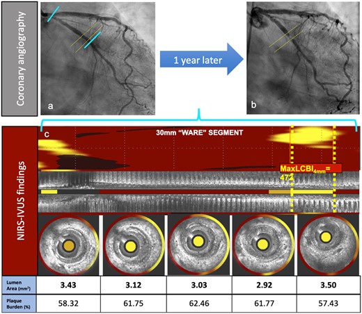 Clinical case illustration. A 64-year-old female patient with past medical history of hypertension, hyperlipidaemia, diabetes mellitus, and smoking. (A) Shows angiography at the non-culprit vessel at index (left circumflex artery). (B) Depicts the adverse event angiography (showing a concentric proximal left circumflex artery lesion) taken when the patient presented to the hospital with complaints of shortness of breath and left sided chest pain upon walking less than a block, which was relieved with rest. CK-MB was within normal limits. EKG showed normal sinus rhythm and non-specific ST-T segment abnormalities. Proximal left circumflex artery lesion was successfully treated with drug-eluting stent implantation. Panel (C) shows IVUS-NIRS longitudinal and cross-sectional details at the location of the maxLCBI4 mm at the index procedure. A focal lipid-rich plaque is shown in the maxLCBI4 mm location in (C).