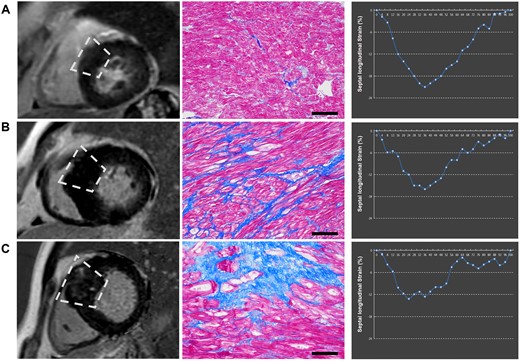 Examples of the presence of LGE, extent of histopathological MF, and septal longitudinal strain. Three cases displaying vary degree of histopathological fibrosis. (A) LGE(−)MF(−). The case showed the absence of LGE and the septal strain parameters at the normal range. (B) LGE(−)MF(+). The case showed the absence of LGE but the septal strain parameters impaired. (C) LGE(+)MF(+). The case showed the presence of LGE and the septal strain parameters impaired. LGE, late gadolinium enhancement; MF, myocardial fibrosis.