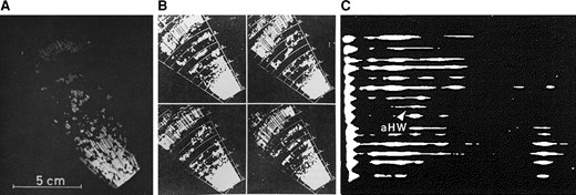 Early 2-dimensional images of the heart and mitral valve, from (A) Hertz 1964114 and (B) Hertz 1967,115 both obtained with a mirror system and recorded on 16 mm film at 7 frames per second; and (C) from Roelandt (1980; page 33)119 recorded about 1971 and described as ‘Stop-frame from the first two-dimensional ultrasonic image obtained from a patient with severe pericardial effusion; aHW = anterior heart wall.’ In this display, the transducer is along the left side of the image, and the echo-free space to the left of the arrow was interpreted as pericardial fluid in front of the heart.