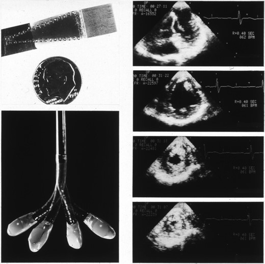 Early monoplane transoesophageal probe and images (courtesy of Professor Peter Hanrath).