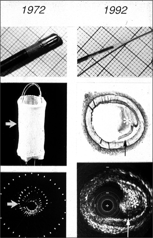 Left: 32-element phased-array 5.6 MHz intravascular ultrasound imaging (IVUS) of a basket (1972). Right: Single element rotating 30 MHz IVUS image of an artery containing atherosclerotic plaque (asterisk, and arrowed) (1992). From Bom N, Lancée CT, Rijsterborgh H, ten Hoff H, Roelandt JRTC. From idea to clinical application. in Intravascular Ultrasound, Roelandt, Gussenhoven, Bom Eds. Kluwer Academic Publishers, 1993.
