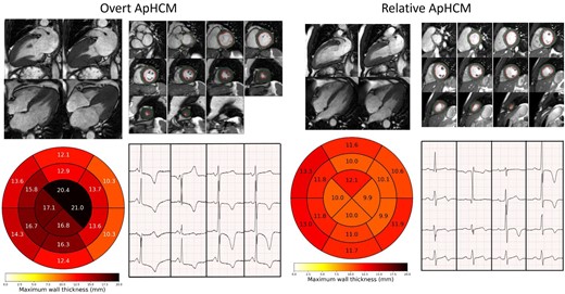 Overt and relative apical HCM examples