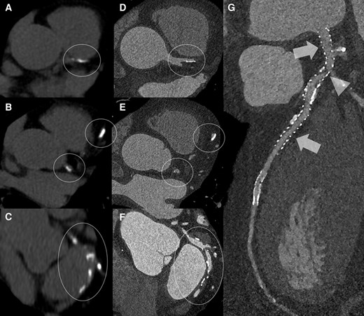 The figure shows examples of CAD as displayed by conventional calcium scoring protocol (A, B, C; inside white circles and ellipses) and corresponding CT coronary angiography images (D, E, F; inside white circles and ellipses) obtained with photon counting CT—PCCT technology (NAEOTOM ALPHA, Siemens Healthineers). It is very clear that the detection and phenotyping of calcifications is going to be dramatically improved by this technology. These improvements will also determine a much better visualization of high attenuation/density structures such as coronary artery stents (G) in which even stent structs will be easily differentiated (arrows) together with in-stent re-stenosis (arrow-head).