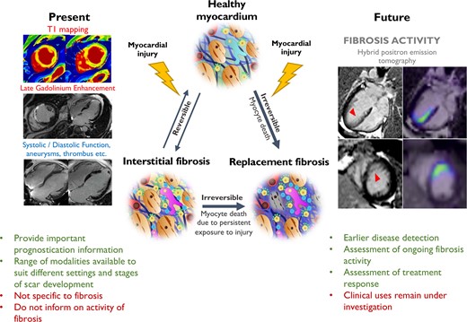 Myocardial fibrosis occurs when various forms of myocardial injury affect previously healthy myocardium. Various existing imaging techniques including cardiovascular magnetic resonance, computed tomography, echocardiography, and nuclear imaging (single-photon emission computed tomography and 18F-FDG PET) assess the extent and pattern of myocardium scar. However, they are not specific to fibrosis and detect established fibrosis that may no longer be modifiable with treatment. Novel molecular fibrosis imaging methods may for the first time allow highly specific imaging of fibrosis activity. Benefits over existing modalities may include detection of the earliest stages of fibrogenesis, differentiation between active and end-stage disease, assessment of response to treatment in vivo as well as determination of the anti-fibrotic potential of existing and novel agents. These new techniques remain under investigation to determine their clinical utility. CMR images of myocardial infarction courtesy of Dr Trisha Singh. 68Ga-FAPI-04 Images courtesy of Dr Zohreh Varasteh.