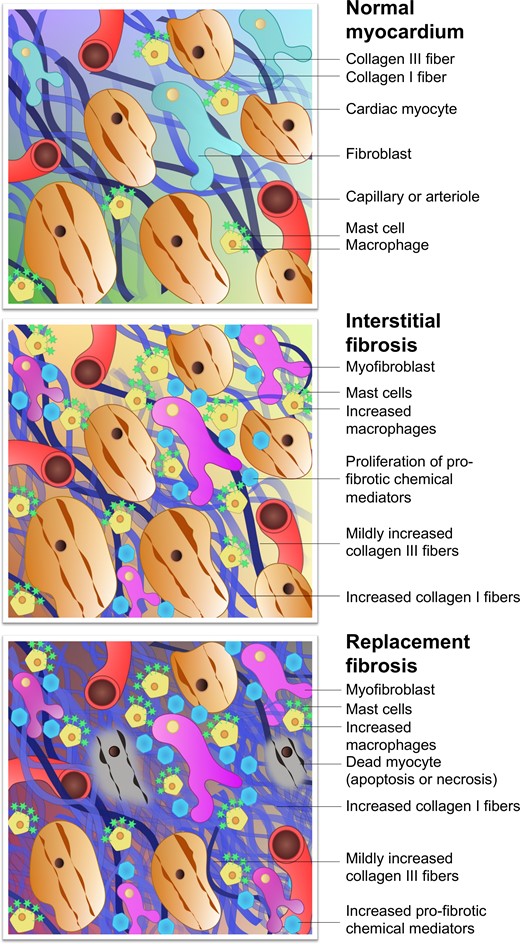 Composition of the normal myocardium and pathological changes of fibrosis. Following myocardial injury, fibroblasts are activated to instigate the transformation from normal myocardium to fibrosis. In interstitial fibrosis, myocyte membranes are not compromised, there is no myocyte death, and a more diffuse pattern of potentially reversible fibrosis ensues. Other more intense forms of injury cause myocyte cell death from the outset, triggering replacement fibrosis seen as focal regions of irreversible cardiac scarring. Interstitial fibrosis can progress to replacement fibrosis in the presence of persistent exposure to myocardial injury. In reality, significant overlap exists between these types but they remain useful when considering the different imaging techniques.