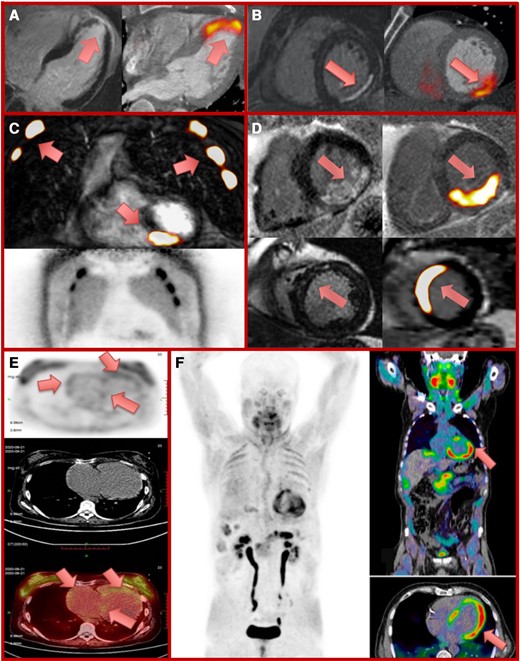 Molecular imaging assessments of myocardial fibrosis activity. Positron emission tomography (PET) radiotracers fused with either computed tomography (CT; PET/CT) or cardiovascular magnetic resonance (CMR; PET/MR) to detect active myocardial damage in a range of conditions. Panels A and B: late gadolinium enhancement (LGE) (left panel) and 18F-fluciclatide PET/CT (right panel) 8 and 13 days following anterior myocardial infarction respectively with intense tracer uptake within the infarct.21 Panel C: intense 68-gallium fibroblast activation protein inhibitor (68Ga-FAPI) uptake on PET/MR within an inferior myocardial infarct in a patient with out-of-hospital cardiac arrest and cardiopulmonary resuscitation. Intense tracer uptake within multiple ribs, representing healing rib fractures (lower panel, 68Ga-FAPI PET image). Panel D: increased 68Ga-FAPI PET/MR uptake within regions of posterior (upper panels) and anteroseptal (lower panels) scar following myocardial infarction in two patients imaged at Days 3 and 8, respectively. Panel E: 68Ga-FAPI PET (top image), CT (middle image), and fused PET/CT image (bottom image) demonstrating right heart 68Ga-FAPI uptake in idiopathic pulmonary artery hypertension and right heart failure. Adapted by permission from Springer Nature Customer Service Centre GmbH: Springer Nature, Wang et al.61 Panel F: 68Ga-FAPI PET (left image), and fused PET/CT (right images) demonstrate left ventricular 68Ga-FAPI uptake in a patient with chemotherapy-induced cardiotoxicity (ejection fraction 41%). Reprinted from Totzeck et al.62