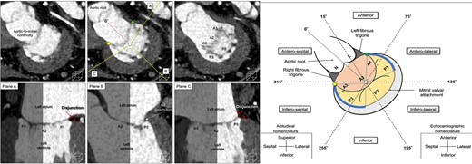Left panel: the quantification of dysjunction hight by CT. Right panel: Blue curves suggest representative locations of the bilateral disjunction. Green and yellow circles denote supero-lateral and infero-medial commissures, respectively. Ninety-four of 98 cases (96%) have disjunction.