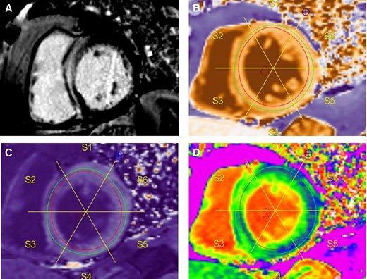 Example of LGE imaging and T1 mapping. Typical septal mid-wall hyperenhancement on LGE imaging (A). Native (pre-contrast) T1 map with blood pool region of interest (ROI) (B). Endocardial and epicardial contours drawn within the myocardium to avoid blood pool signal contamination, and segmentation. Corresponding post contrast T1 map with blood pool ROI and copied segmentation scheme (C). ECV map with corresponding segmentation (D).