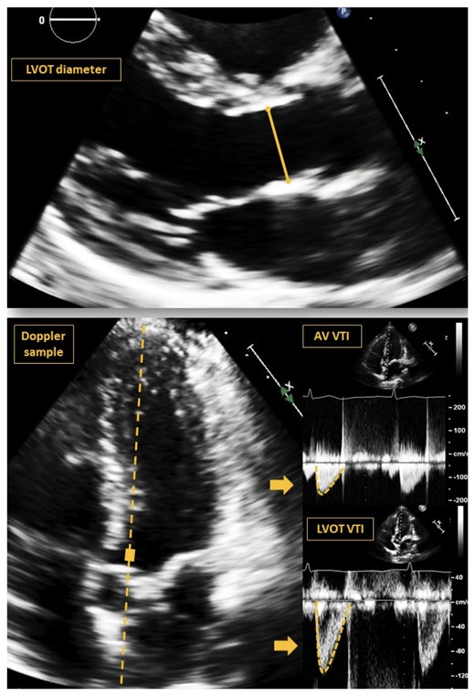 Example of images and measurements performed on a 35-year-old african American woman. LVOT, left ventricular outflow tract, VTI, velocity–time integer, AV, aortic valve.