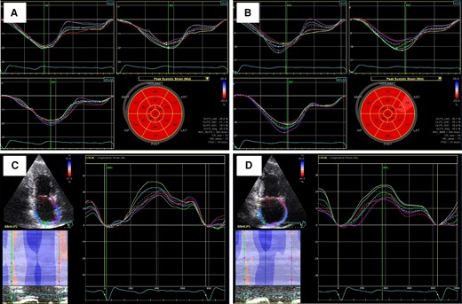 Carfilzomib-induced left ventricular and left atrial markers deterioration. GLS measurement at baseline (A) and at 6 months (B). PALS measurement at baseline (C) and at 6 months (D). GLS, global longitudinal strain; PALS, peak atrial longitudinal strain.