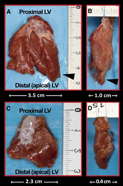 Resected septal muscle at myectomy. Antero-posterior and lateral views of the resected muscle from the anterior ventricular septum in a patient with obstructive HCM and particularly marked septal hypertrophy (35 mm) (A and B) and one with mild septal hypertrophy (16 mm) (C and D). The cardiac muscle was resected via two incisions in the basal septum 2 to 3 mm below the aortic valve and extended distally to the base of the papillary muscles. Anomalous muscle bundles that contributed to reduce the size of the midventricular cavity were also resected (arrowheads).