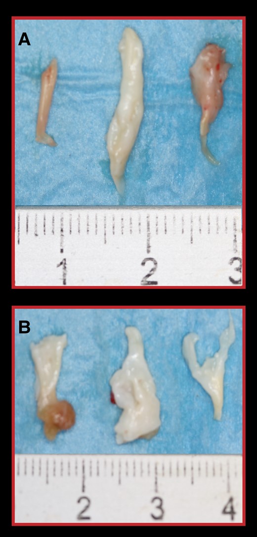 Resected fibrotic and retracted secondary chordae of the anterior MV leaflet in the two patients showed in Figure 2. (A) Secondary chordae from the patient A–B. (B) Secondary chordae from the patient C–D.