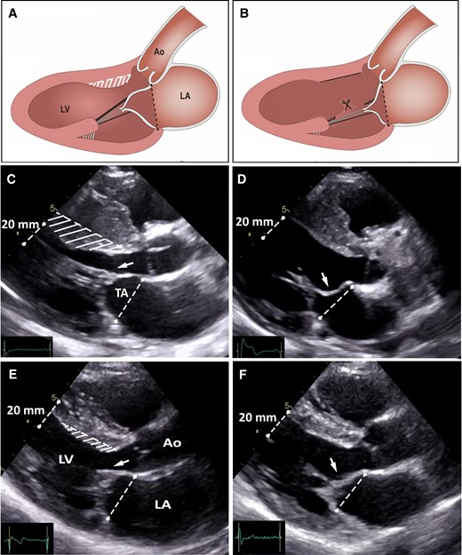 Illustration of the operative results. (A and B) Schematic representation of the traction exerted by fibrotic secondary MV chordae on the AML, and the results of resecting fibrotic secondary chordae (combined with a shallow myectomy) on the MV apparatus. (C and D) Pre-operative and post-operative echocardiographic images obtained in early systole in a patient with obstructive HCM and marked septal thickness, and (E and F) in a patient with obstructive HCM and mild septal thickness. Preoperatively, in both patients, fibrotic and retracted secondary AML chordae cause abnormal tethering of the AML with displacement of the MV valve apparatus towards the LV outflow tract (arrows). Postoperatively, the AML tethering is abolished (arrows), the MV apparatus has moved away from the LV outflow tract to a more posterior and normal position in the LV cavity. The MV tenting area is also substantially reduced.