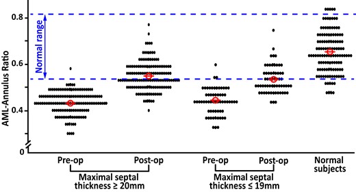 MV position at onset of systole, assessed before and after surgery as AML-annulus ratio. AML secondary chordae were resected in 150 patients with important and 62 patients with mild septal hypertrophy in association with a relatively shallow septal myectomy. The MV position in a control group of normal subjects is also shown.
