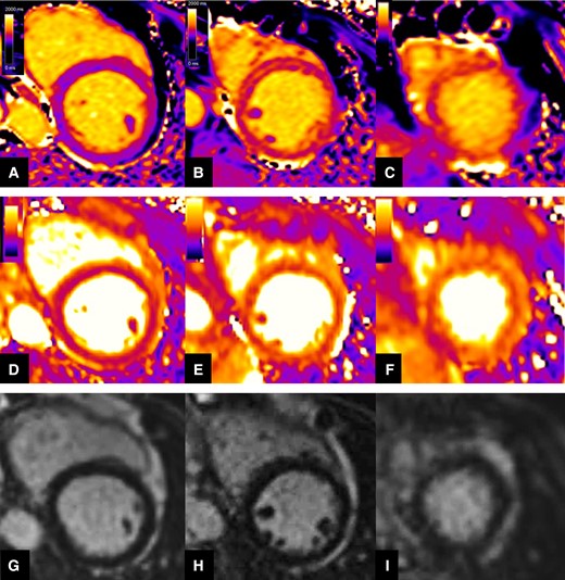 Representation of native T1 (top row), T2 mapping (mid row), and LGE (bottom row) qualitative assessment in a patient with acute TTS. Native T1 and T2 mapping displayed progressive increase of signal intensity from base (Panels A and D) to mid (Panels B and E), and apical (Panels C and F) LV wall level, consistent with wide myocardial oedema more extensively affecting the apical segments and presenting a non-coronary distribution. Negative LGE imaging (Panels G, H, and I).
