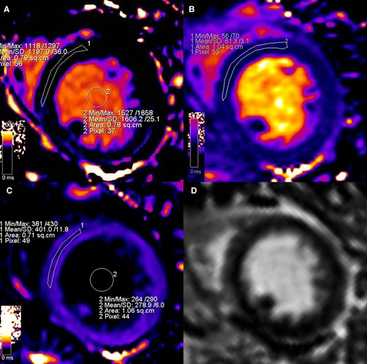 Representation of parametric assessment of tissue mapping features. Strong windowing was used to reduce the bias linked to colour visualization.26 A ROI conservatively drawn in the septum from the mid-short-axis slice was used to assess myocardial native T1 (Panel A, 1197 msec), T2 (Panel B, 61.3 msec), and post-contrast T1 (Panel C, 401 msec). Native (Panel A, 1606 msec) and post-contrast (Panel C, 278.9 msec) blood T1 was measured placing a ROIs within the LV lumen and then used, along with haematocrit level, to calculate the ECV (32% in this case) according to the formula described in the literature.26 LGE imaging (Panel D) was performed and used as a guidance for avoidance of scar, not present in this case, when positioning the ROIs during mapping assessment.