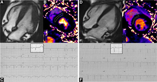 Representative case of a TTS patient in our cohort, who underwent serial CMR scans in the acute phase (left panels) and then at a 1-month follow-up (right panels). In the acute phase, concentric left ventricular hypertrophy is found (Panel A, end-diastolic frame from four-chamber cine images), accompanied by myocardial oedema (Panel B, 57.9 msec); the ECG shows diffuse T-wave inversion; aVR QRS complex has been magnified in the highlighted box (Panel C). At follow-up, left ventricular hypertrophy partly regresses (Panel D, end-diastolic frame from four-chamber cine images) and myocardial oedema ameliorates (Panel E, 51.9 msec); the ECG shows improvement of repolarization abnormalities (Panel F); aVR QRS voltage has increased (magnified in the highlighted box). Clips from cine images are available as supplementary material.
