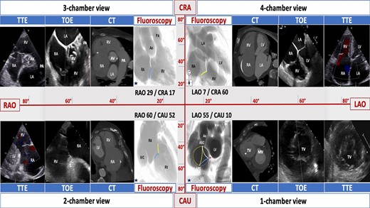 The 4 right-sided chamber views