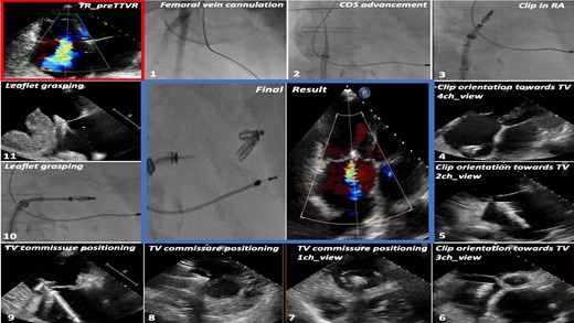 Methodology of TTE guidance of TTVR