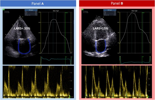 A demonstration of the acquisition of LARS in patients undergoing TAVI for severe aortic stenosis, with left atrial strain curves and corresponding transmitral pulsed wave Doppler flow. (A) A patient with Grade 0/1 LARS-DD (LARS 33%), who survived at long-term follow-up. (B) A patient with Grade 3 LARS-DD (LARS 15%). This patient did not survive at long-term follow-up. LARS, left atrial reservoir strain; LARS-DD, left atrial reservoir strain diastolic dysfunction; TAVI, transcatheter aortic valve implantation.