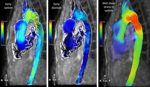 Flow patterns using path lines and wall shear stress derived from 4D flow CMR in a patient with hypoplastic left heart syndrome after Norwood procedure.