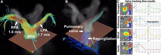 Whole-heart 4D flow CMR of a 14-year-old male after arterial switch operation with the Lecompte manoeuver. Narrowing of the pulmonary arteries is a typical complication of this operation. Assessment of branch pulmonary by echocardiography was inconclusive. Using 4D flow CMR, a peak velocity in the left pulmonary artery of 1.7 m/s and in the right pulmonary artery of 1.6 m/s was measured (A), suggesting mild narrowing of both arteries. Furthermore, assessment of pulmonary valve regurgitation (B, C) and flow assessment of aortic as well as atrioventricular valves (C) was possible. With 2D flow CMR imaging, it would have been more difficult to accurately measure branch pulmonary artery peak velocities because visualization of the area with the highest velocity is more difficult. Courtesy of Dr Joost van Schuppen (Department of Radiology and Nuclear Medicine, Amsterdam University Medical Center).