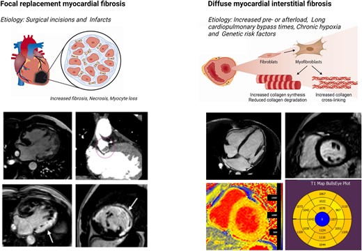 Focal myocardial replacement fibrosis, myocardial necrosis, and myocyte loss are commonly associated with surgical incisions and infarcts. An example of this is seen in a patient with hypoplastic left heart syndrome and a large infarct, indicated by arrows, along with a thrombus in the Damus–Kaye–Stansel anastomosis shown by a red circle. Diffuse myocardial fibrosis can be evaluated by parametric mapping in patients with increased pre- or afterload, long cardiopulmonary bypass times, chronic hypoxia, or genetic risk factors. An example of this is seen in a patient with moderate mitral regurgitation. The short-axis T1 mapping revealed significant cardiac remodelling and diffuse fibrosis prior to the development of symptoms. Late gadolinium enhancement was not detected, as its detection relies on the spatial heterogeneity of fibrosis, which was not present in the non-infarcted myocardium of this patient.