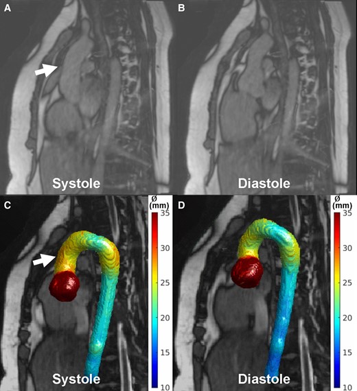 Systolic (A) and diastolic (B) images from an aortic 3D cine acquisition (pseudo-spiral undersampling, scan time ∼4 min, acquired/reconstructed spatial resolution 1.6/1.0(mm)3, temporal resolution ∼67 ms/15 cardiac phases, TR/TE/FA: 2.9 ms/1.44 ms/40°) in a 22-year-old female with the Marfan syndrome. With nnU-Net, 4D segmentations were created followed by 4D diameter calculation showing a larger diameter in the ascending aorta in systole (A, C, arrows) compared with diastole (B, D). Courtesy of Daan Bosshardt and Renske Merton (Department of Radiology and Nuclear Medicine, Amsterdam University Medical Center).