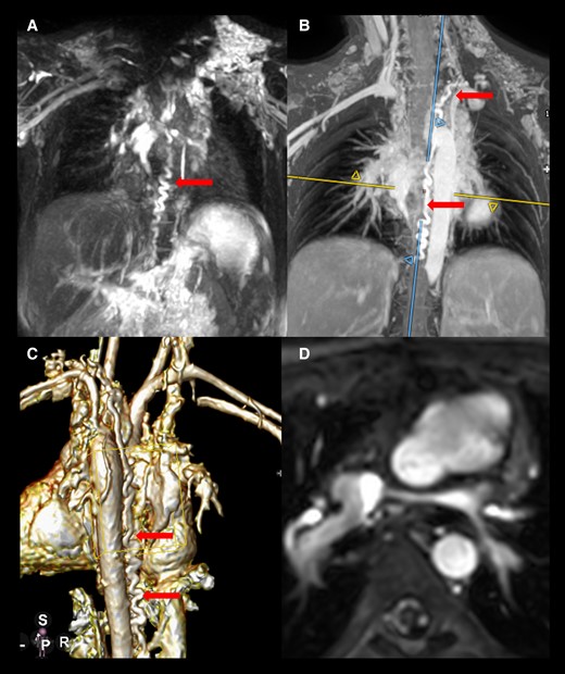 Static lymphatic imaging using a 3D gradient echo and spin echo and 3D modified Dixon technique in a 6-year-old girl with hypoplastic left heart syndrome and plastic bronchitis (A–C). She has a bilateral and bidirectional upper cavopulmonary connection. Both the left pulmonary artery and the connection between the right-sided hemi-Fontan and the left Glenn anastomosis are hypoplastic (D) possibly creating a drainage problem for the left-sided thoracic duct that is dilated and tortuous.