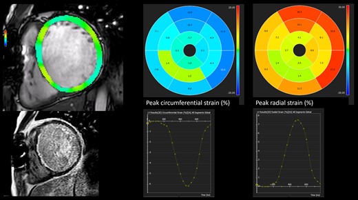 2D feature tracking in a 29-year-old male status post-repair of subaortic stenosis, cor triatriatum, and ventricular septal defect who also underwent resection of subaortic re-stenosis. Subendocardial late gadolinium enhancement is present (red arrows). Longitudinal and circumferential peak strain values are significantly reduced.