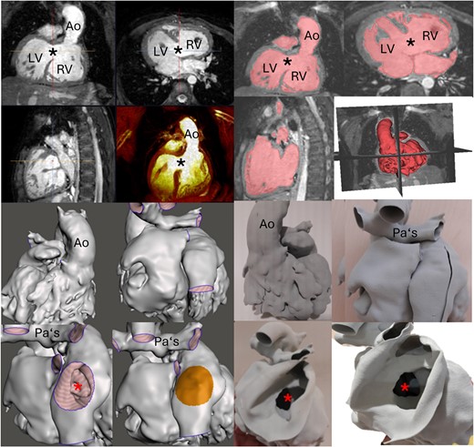CMR evaluation of a 10-year-old patient with atrioventricular and ventriculo-arterial discordance, pulmonary atresia, and ventricular septal defect (black star) post-Glenn operation. The upper eight images show images from a 3D steady-state free precession sequence and their segmentation. The lower eight images show the virtual and printed cardiac model. Ao, aorta; atrial septal defect, red star; LV, left ventricle; PAs, pulmonary arteries; RV, right ventricle.