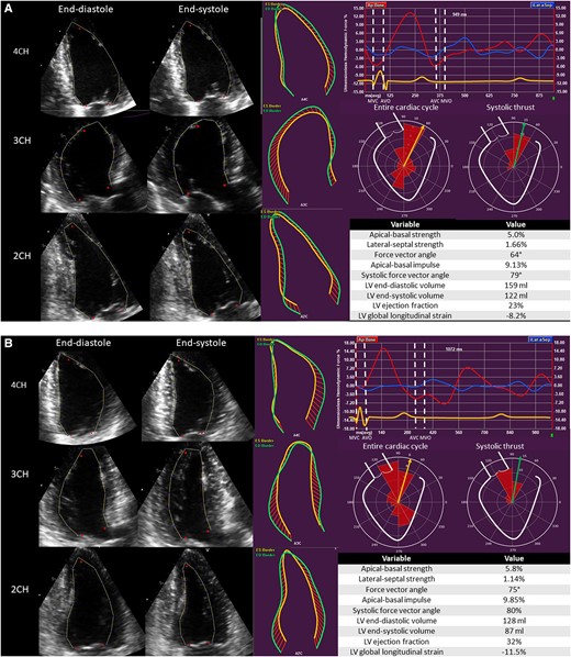 Haemodynamic force analysis in a patient with non-ischaemic cardiomyopathy implanted with a CRT device. (A) Before CRT implantation. (B) Six months after CRT implantation. 2CH, two-chamber view; 3CH, three-chamber view; 4CH, four-chamber view; AVC, aortic valve closure; AVO, aortic valve opening; LV, left ventricular; MVC, mitral valve closure; MVO, mitral valve opening.