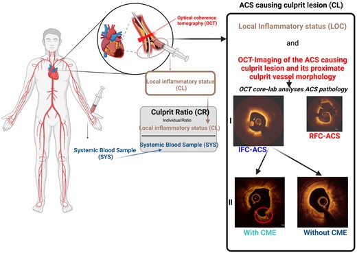 Assessment of inflammatory coronary vessel wall interactions by immunophenotyping. Each patient received simultaneous OCT imaging of the ACS-causing CL and local and systemic immunophenotyping used to calculate an intra-individual culprit ratio. ACS, acute coronary syndrome; CL, culprit lesion, IFC, intact fibrous cap; OCT, optical coherence tomography; RFC, ruptured fibrous cap.