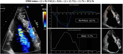 Representative case of STREI calculation in a patient with severe TR.